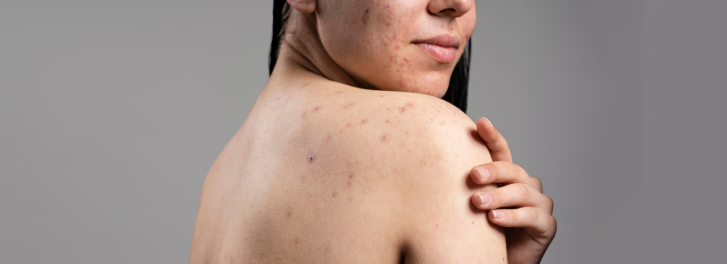 acne-ativa