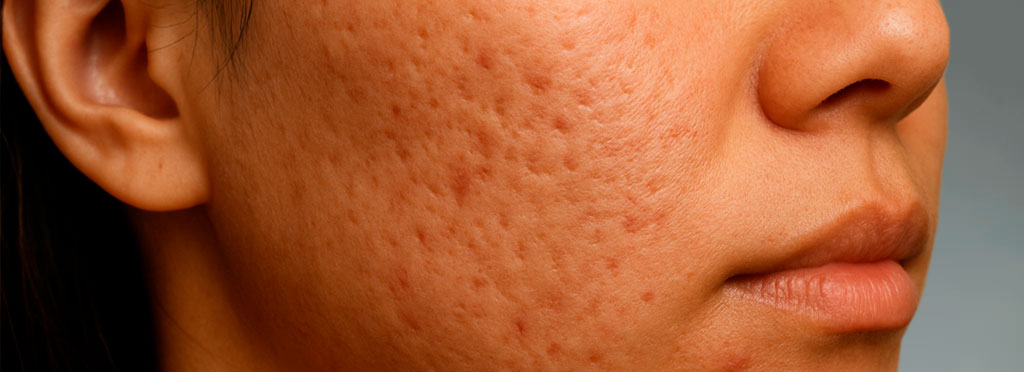 acnecicatriz