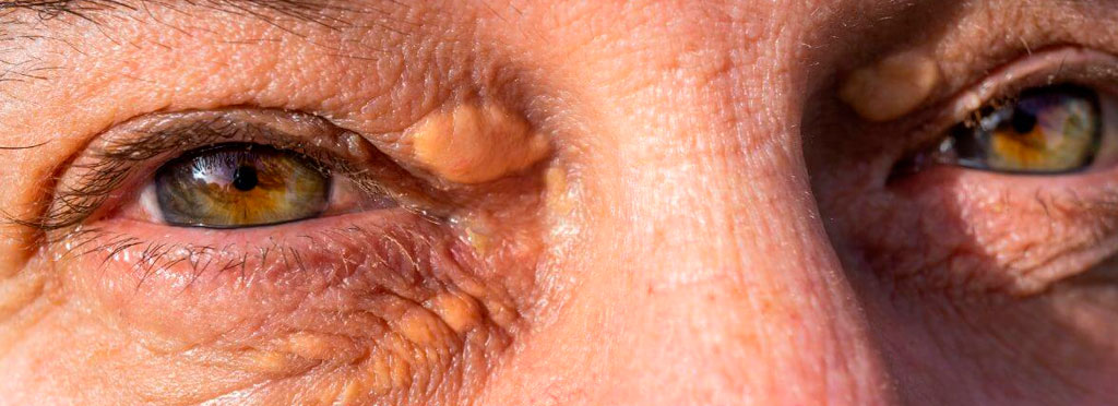 xantelasma